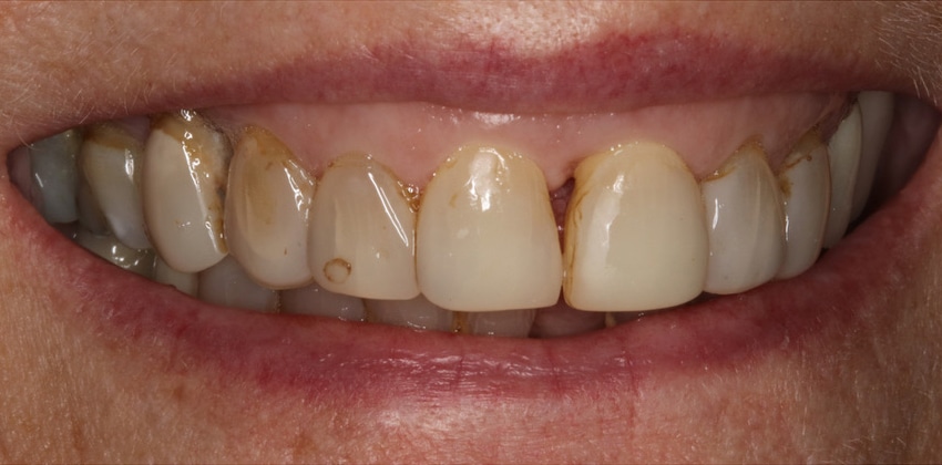 Before Image: Porcelain Veneers - front