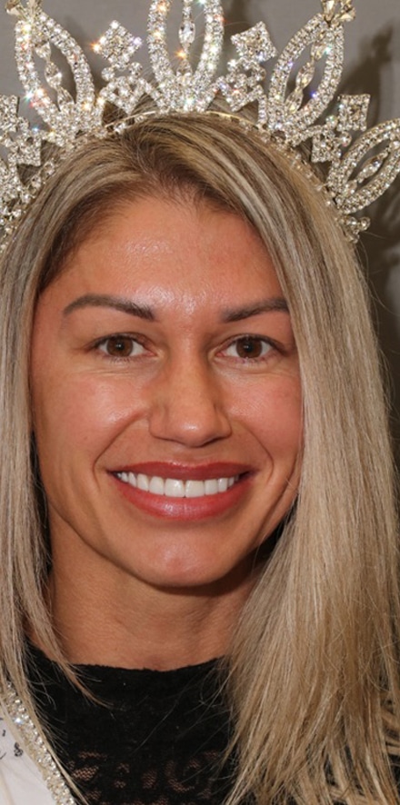 After Image: Porcelain Veneers - front